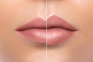 Comparison of beautiful emale lips after augmentation photo