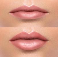 Comparison of beautiful emale lips after augmentation photo