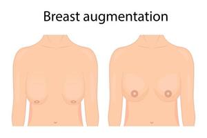 Vector illustration of breast plastic surgery. before and after. For advertising and economic publications