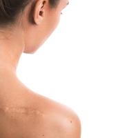 Woman with a scar on her shoulder photo