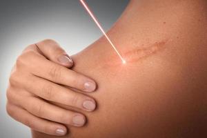 Female shoulder and laser beam during scar removal photo