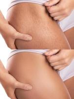 Comparison female hips after stretch mark removal treatment photo