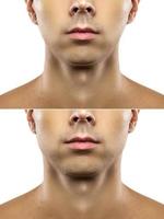 Surgery or mewing exercises. Result of a jawline reshape. photo