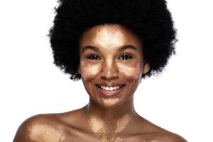 Beautiful black woman with vitiligo skin disorder photo