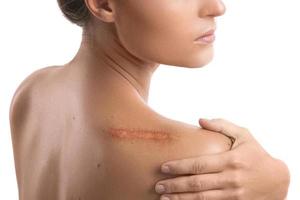 Woman with a scar on her shoulder photo