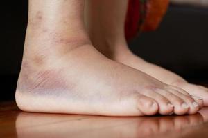 close up of women feet with swelling photo