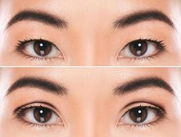 East Asian blepharoplasty or double eyelid surgery photo