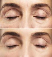 Anti aging treatment. Female eyes after rejuvenation. photo