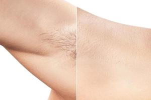 Comparison of female armpit after hair removal photo