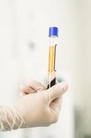 Vacutainer with a platelet-rich plasma and blood for PRP treatment photo