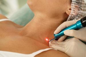 Woman during laser removal of pigmentation or birthmarks in a medical aesthetic clinic photo