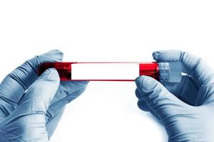 Close up of scientist hand with a blood ampoule photo