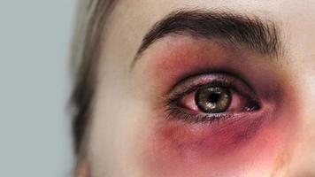 Victim of a domestic violence with bruise and subconjunctival hemorrhage photo