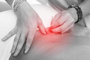 Close-up of female body with steel needles inserted during procedure of acupuncture therapy photo