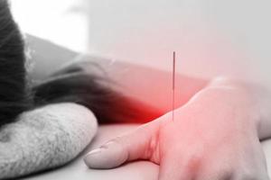 Close-up of female body with steel needles inserted during procedure of acupuncture therapy photo