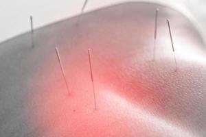 Close-up of female body with steel needles inserted during procedure of acupuncture therapy photo