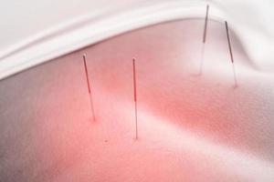 Close-up of female body with steel needles inserted during procedure of acupuncture therapy photo