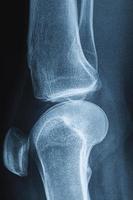 X-ray image of human knee photo