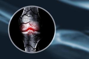 concepto de imagen de rayos x de osteoporosis con huesos rotos foto