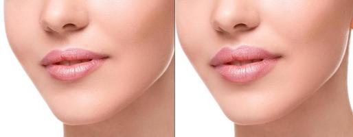 Lips  before and after augmentation photo