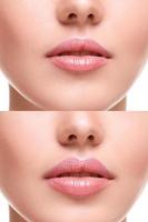 Lips  before and after augmentation photo