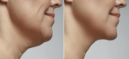 Double chin removal, facelift and neck liposuction photo