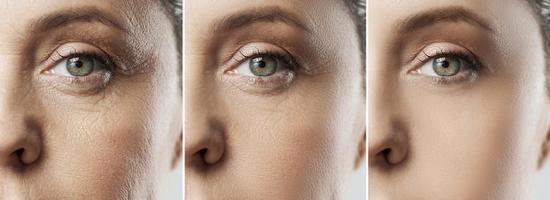 rostro femenino después de un proceso de rejuvenecimiento increíble o retoque pesado foto