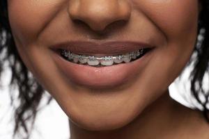 primer plano de la sonrisa de una mujer negra con aparatos dentales en los dientes foto