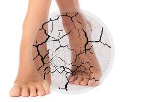 Concepts of cracked heel or other skin problems photo