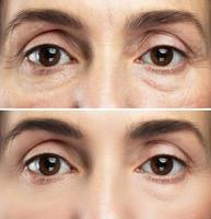 tratamiento antienvejecimiento. ojos femeninos después del rejuvenecimiento. foto