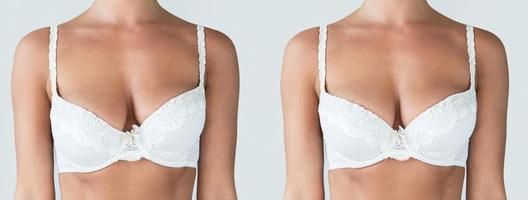 Comparison before and after breast asymmetry correction surgery photo