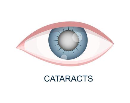 Cataract eye close up view. Eyeball with cloudy lens. Anatomically accurate human organ of vision with aging problems vector