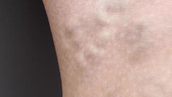 leg with varicose vein closeup video