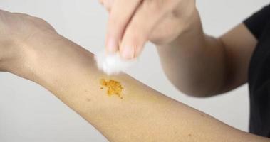 treatment of radiation burns with iodine, lubricate the wound on the arm with iodine video