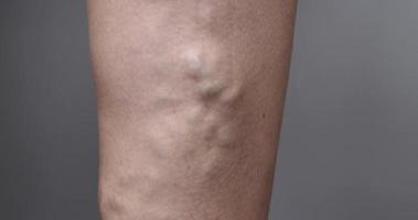 female legs with varicose veins on gray background video