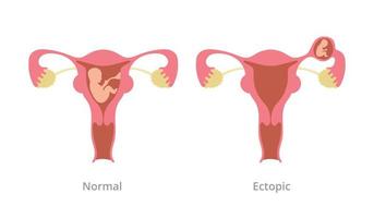 ectopic pregnancy pregnancy problem with comparison with normal pregnancy with modern flat style vector