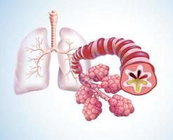 Ilustración 3d de la tráquea y los sacos de aire en los pulmones humanos que destacan la bronquitis y se llenan de flema. vector