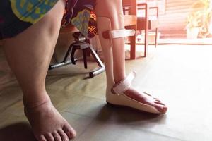 Foot splint for treatment photo