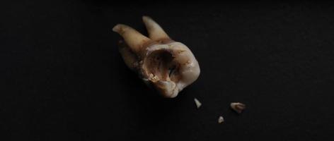 Macro shot of a decayed teeth till root after extraction of dentist. photo