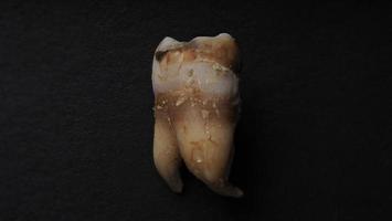 Macro shot of a decayed teeth till root after extraction of dentist. photo