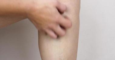 hand combing leg with varicose vein, itching in the sore leg video