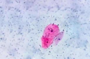 frotis de Papanicolaou bajo microscopía que muestra un frotis inflamatorio con cambios relacionados con el VPH. cáncer de cuello uterino. scc foto