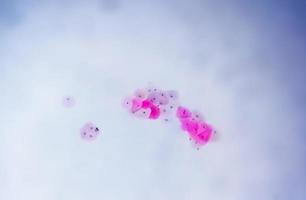 Paps smear under microscopy showing inflammatory smear with hpv related changes. Cervical cancer. SCC photo