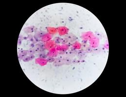 frotis de Papanicolaou bajo microscopía que muestra un frotis inflamatorio con cambios relacionados con el VPH. cáncer de cuello uterino. scc foto