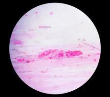 Paps smear under microscopy showing inflammatory smear with hpv related changes. Cervical cancer. SCC photo