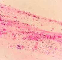 Paps smear under microscopy showing inflammatory smear with hpv related changes. Cervical cancer. SCC photo