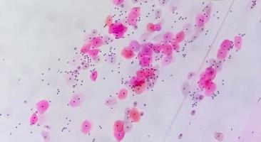 Paps smear under microscopy showing inflammatory smear with hpv related changes. Cervical cancer. SCC photo