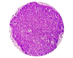 Photomicrograph showing tongue squamous cell carcinoma Grade II. Oral Invasive SCC. photo