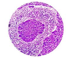 microfotografía que muestra carcinoma de células escamosas de lengua grado ii. SC invasivo oral. foto