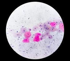 Paps smear under microscopy showing inflammatory smear with hpv related changes. Cervical cancer. SCC photo